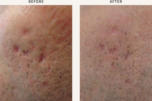 SUBCISION & FRACTIONAL LASER RESURFACING - ACNE SCAR