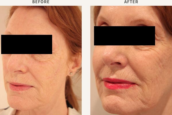 ANTI-WRINKLE INJECTION - FROWN LINES, FOREHEAD, BROW LIFT, CROWS FEET<br/>FILLER - MID CHEEK ENHANCEMENT