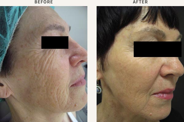 ANTI-WRINKLE INJECTION - FROWN LINES, FOREHEAD, BROW LIFT, CROWS FEET<br/>FILLER - MID CHEEK, TEMPLE & BROW ENHANCEMENT<br/>BROADBAND LIGHT PHOTO-REJUVENATION - FULL FACE REJUVENATION