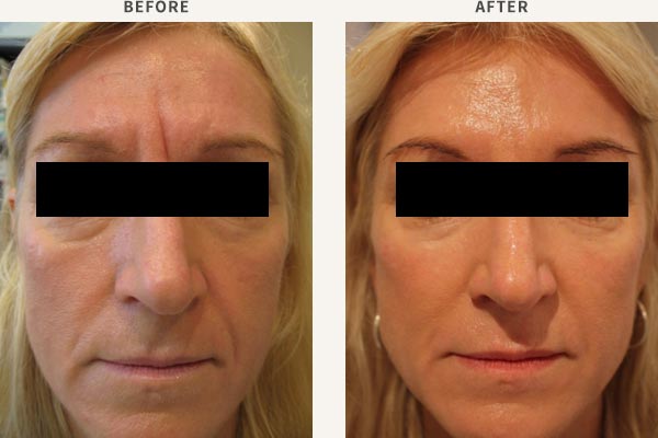 FILLER - MID CHEEK, TEMPLE & BROW ENHANCEMENT<br/>ANTI-WRINKLE INJECTION - FROWN LINES, FOREHEAD, BROW LIFT, CROWS FEET