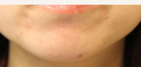 ACNE - AFTER TREATMENT