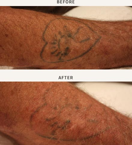 Laser Tattoo Removal Sydney, Chatswood & Sutherland Shire | Sydney  Dermatology Group