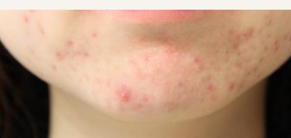 ACNE - BEFORE TREATMENT