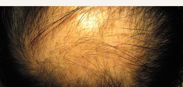 HAIR LOSS - MALE PATTERN ALOPECIA
