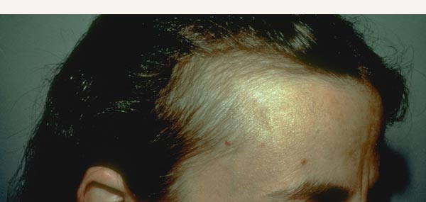 HAIR LOSS - TELOGEN EFFLUVIUM