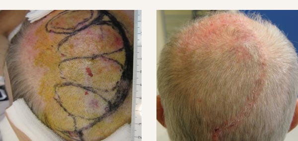 EXCISION OF SCALP BASAL CELL CARCINOMA - ROTATION FLAP REPAIR