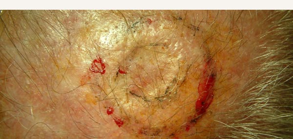 EXCISION OF SQUAMOUS CELL CARCINOMA - FULL THICKNESS SKIN GRAFT REPAIR