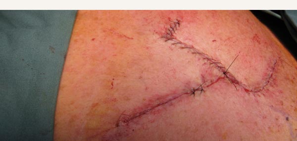 EXCISION OF BASAL CELL CARCINOMA - BILATERAL ADVANCEMENT FLAP REPAIR