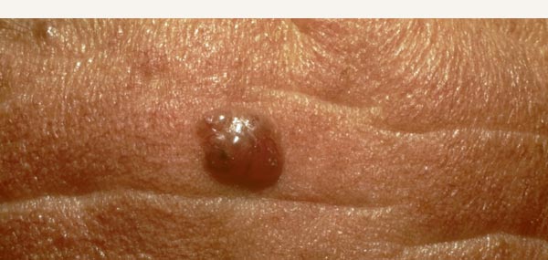 PIGMENTED BASAL CELL CARCINOMA