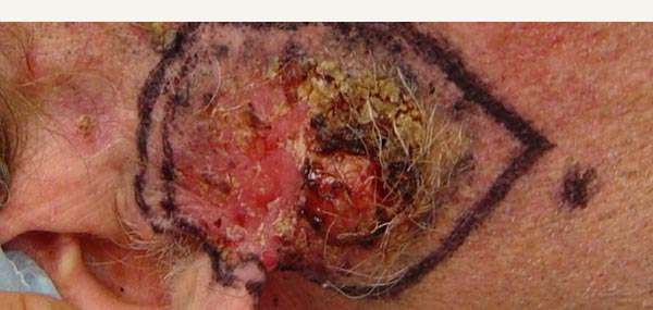 BOWEN'S DISEASE AND SQUAMOUS CELL CARCINOMA - BILOBE FLAP REPAIR