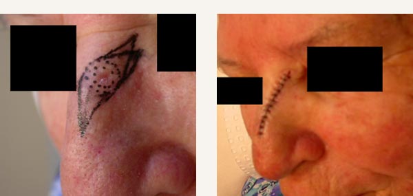 EXCISION OF NASAL BASAL CELL CARCINOMA - PRIMARY CLOSURE