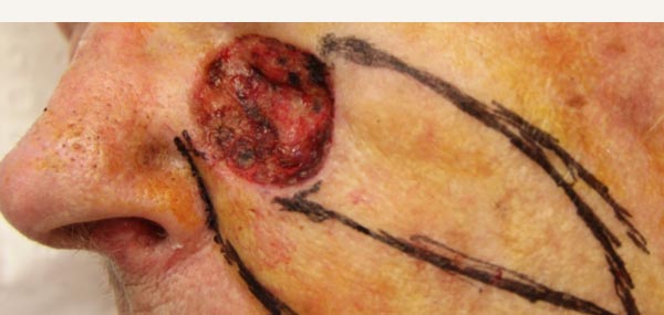 EXCISION OF SQUAMOUS CELL CARCINOMA - ISLAND PEDICLE FLAP REPAIR